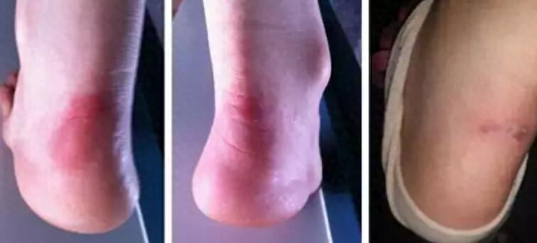 為什么一只鞋磨腳一只不磨？（鞋后跟磨腳的小妙招）